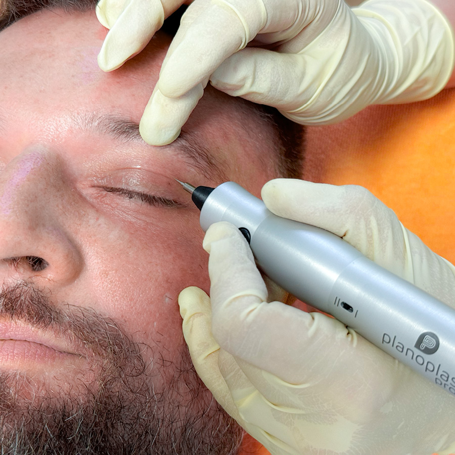 Plasma-Pen-Behandlung