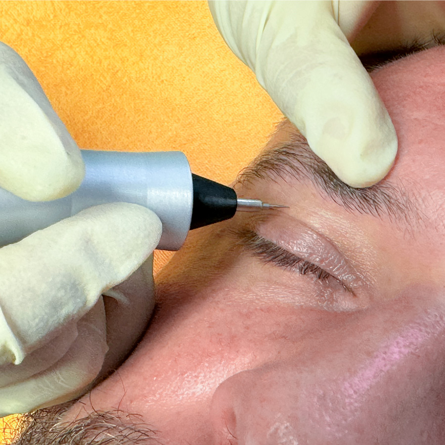 Plasma Pen Behandlung Berlin – straffere Haut ohne Operation