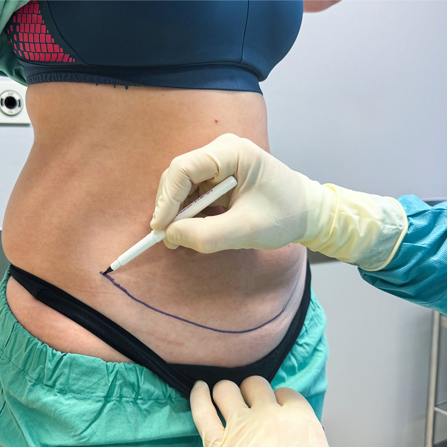 Bauchdeckenstraffung (Abdominoplastik)