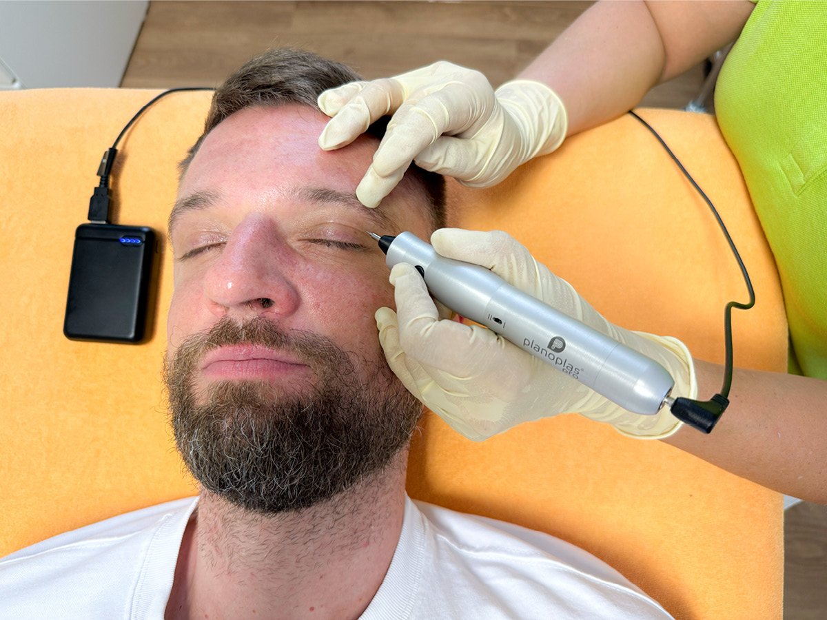 Behandlung Plasma-Pen-Behandlung Berlin – schonend zu jüngerem Aussehen
